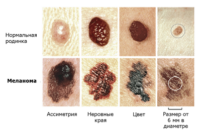 Как выглядит нормальная родинка и меланома