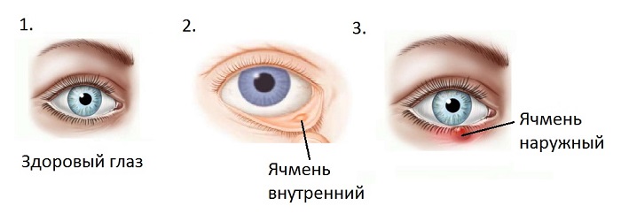 Внутренний и наружный ячмень на глазу