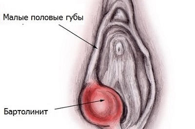 Бартолинит на половых органах у женщин