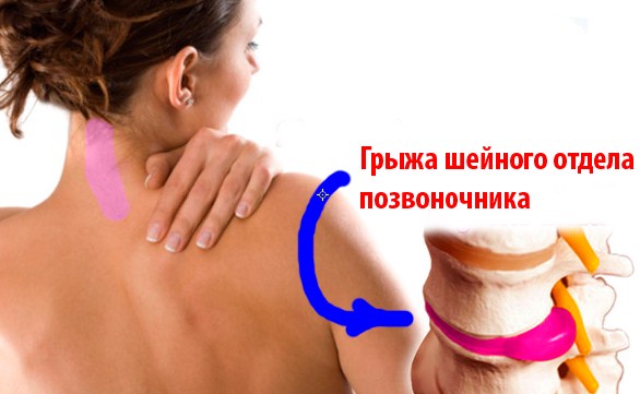 Грыжа шейного отдела позвоночника.