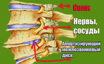 Что такое отложение солей в позвоночнике. Чем они опасны?