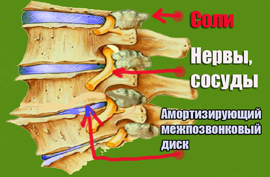 Что такое отложение солей в позвоночнике. Чем они опасны?